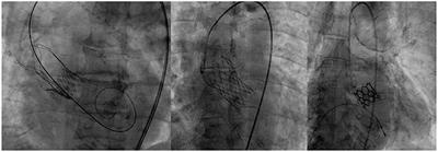 Transcatheter Aortic Valve Implantation: A Report on Serbia's First Systematic Program